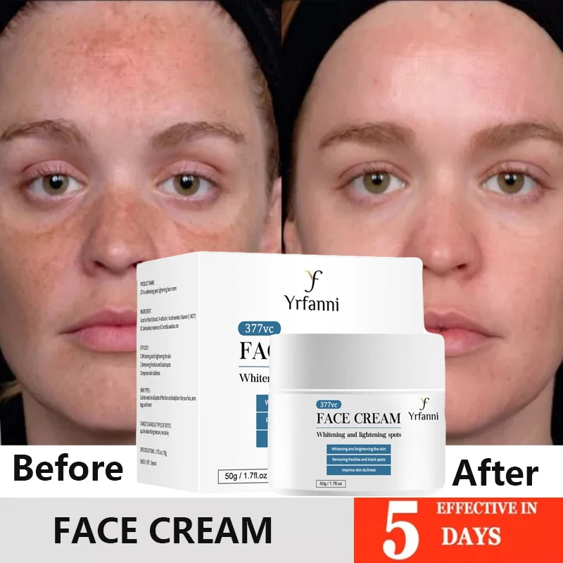 Whitening Freckles Cream Remove Dark Spots Melasma Lightening Melanin Fade Chloasma Brighten Moisturize Facial Korea Skin Care
Whitening Freckles Cream Remove Dark Spots Melasma Lightening Melanin Fade Chloasma Brighten Moisturize Facial Korea Skin Care