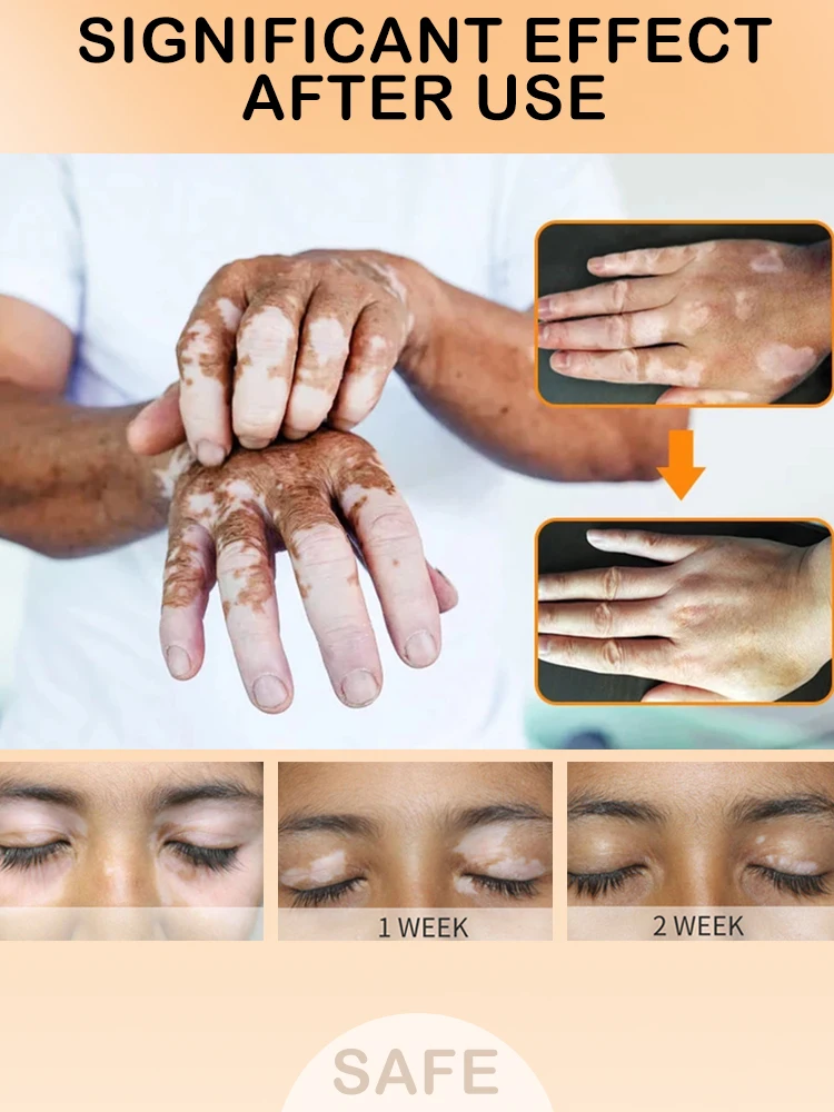 

Vitiligo cream Eliminate ringworm white spots Get rid of skin vitiligo