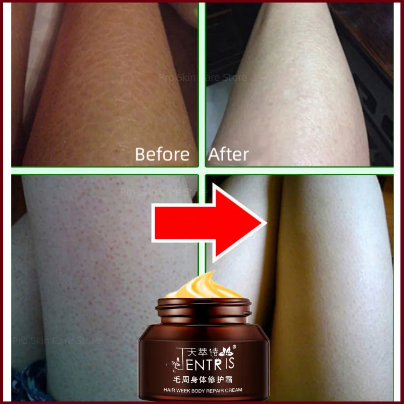 50g Chicken Skin Repair Cream Curing Keratosis Pilaris Body Lotion Anti-chapped Rough Improve Horny Removal Nourish Moisturizer
50g Chicken Skin Repair Cream Curing Keratosis Pilaris Body Lotion Anti-chapped Rough Improve Horny Removal Nourish Moisturizer