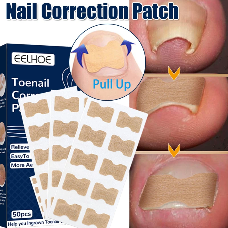 50pcs Nail Correction Stickers Ingrown Toenail Paronychia Treatment Corrector Waterproof Elastic Painless Patches Pedicure Tools
50pcs Nail Correction Stickers Ingrown Toenail Paronychia Treatment Corrector Waterproof Elastic Painless Patches Pedicure Tools