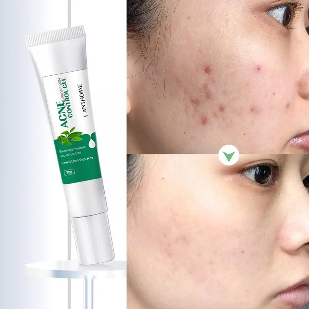 20g Acne Removal Gel Acne Treatment Repair Moisturizing Print Skin Acne Care Oil Whitening Control Remove Shrink Pores C7N8
20g Acne Removal Gel Acne Treatment Repair Moisturizing Print Skin Acne Care Oil Whitening Control Remove Shrink Pores C7N8