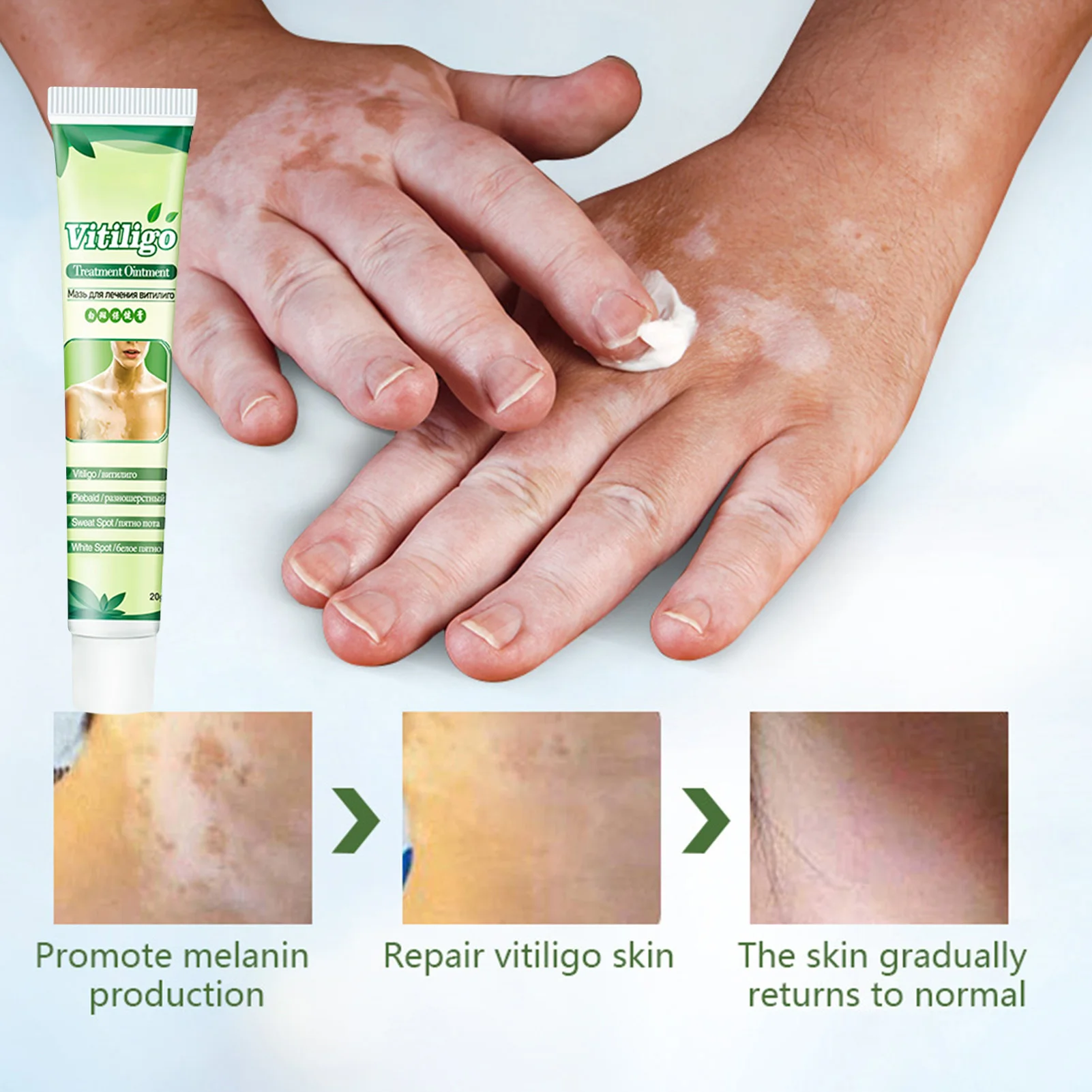 Vitiligo Care Cream External Vitiligo Treatment Improve Skin Pigmentation And Get Rid Of White Spots On Skin Body Creams For
Vitiligo Care Cream External Vitiligo Treatment Improve Skin Pigmentation And Get Rid Of White Spots On Skin Body Creams For