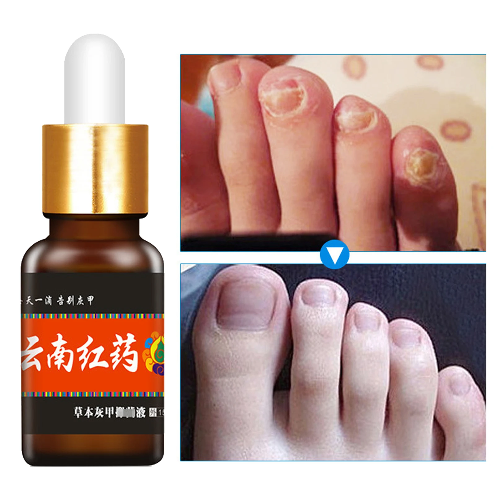 Nail Fungal Treatment Feet Care Essence Foot Whitening Toe Nail Fungus Removal Gel Anti Infection Paronychia Onychomycosis 15ml
Nail Fungal Treatment Feet Care Essence Foot Whitening Toe Nail Fungus Removal Gel Anti Infection Paronychia Onychomycosis 15ml