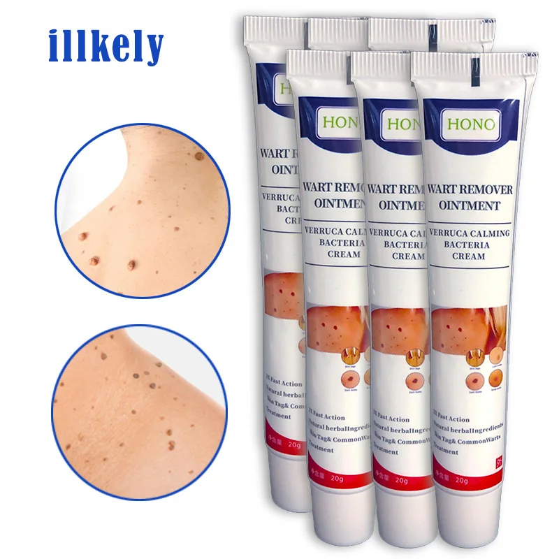 

Wart Remover Cream Warts Corn Treatment Ointment Skin Tag Genital Herpes Papilloma Liquid Moles Herbal Beauty Health Face Care