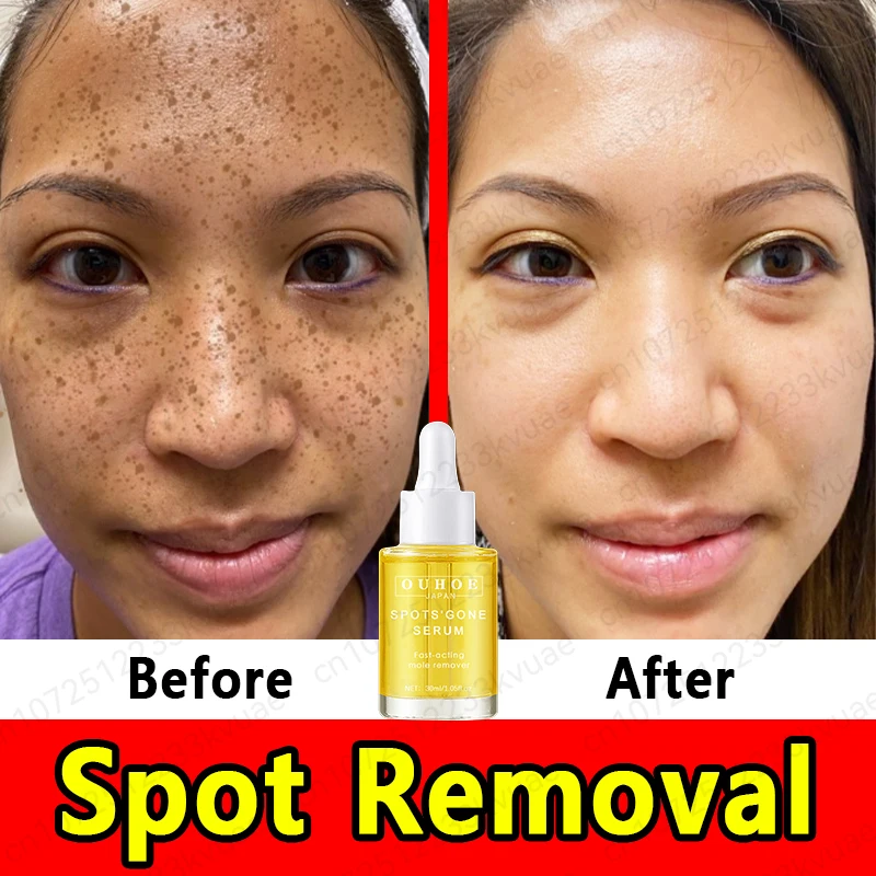 Whitening Spot Serum Remove Freckles Chloasma Dark Spots Hyperpigmentation Age Spots Sun Spots Light Spots And Brighten Skin
Whitening Spot Serum Remove Freckles Chloasma Dark Spots Hyperpigmentation Age Spots Sun Spots Light Spots And Brighten Skin