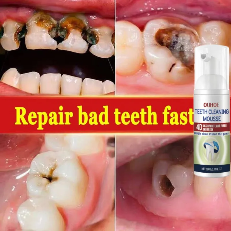 Highly Effective Anti-cavity Tooth Decay Repair Tooth Decay Remove Plaque Toothache Relieve Periodontitis Teeth Whitening Care
Highly Effective Anti-cavity Tooth Decay Repair Tooth Decay Remove Plaque Toothache Relieve Periodontitis Teeth Whitening Care
