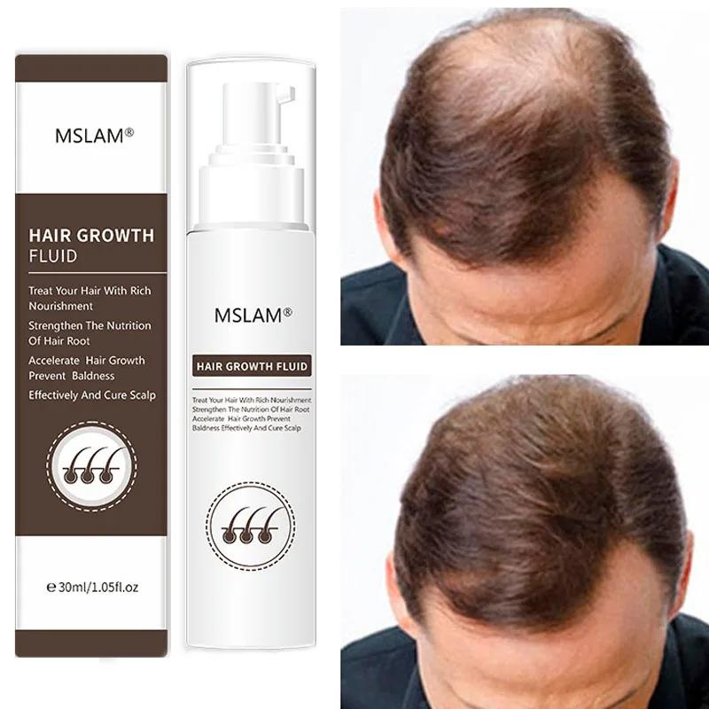 

Hair Growth Spray Natural Anti Hair Loss Repair Nourish Hair Roots Effective Prevent Baldness Product Scalp Care Men Women