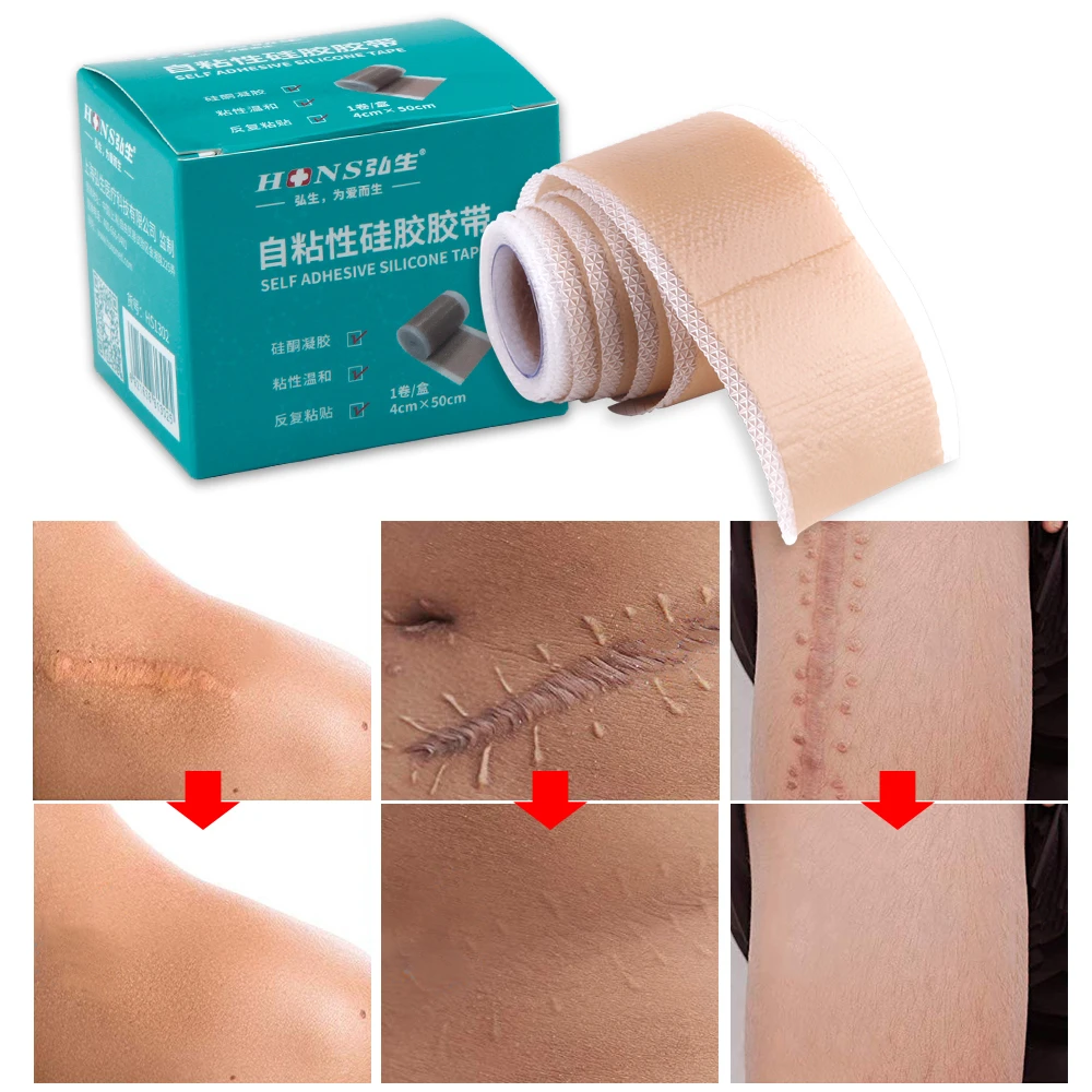 

4x50cm Silicone Scars Patch Wounds Band Remove Acne Burn Scar Treatment Cover Ear Correctors Efficient Repair Damaged Skin Sheet