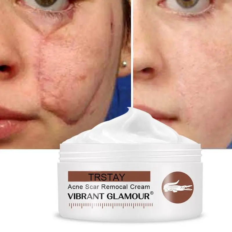 Pregnancy Repair Cream Stretch Mark Removal Removal Acne Scar Stretch Marks Cream Fat Striae Gravidarum Treatment Body Creams 
Pregnancy Repair Cream Stretch Mark Removal Removal Acne Scar Stretch Marks Cream Fat Striae Gravidarum Treatment Body Creams