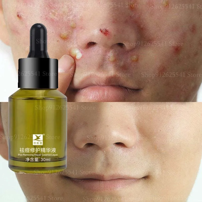 Anti Pimples Spots Scars Removal Essence Shrink Pores Acne Removing Repairing Face Serum Oil Control Repair Skin Care Products
Anti Pimples Spots Scars Removal Essence Shrink Pores Acne Removing Repairing Face Serum Oil Control Repair Skin Care Products