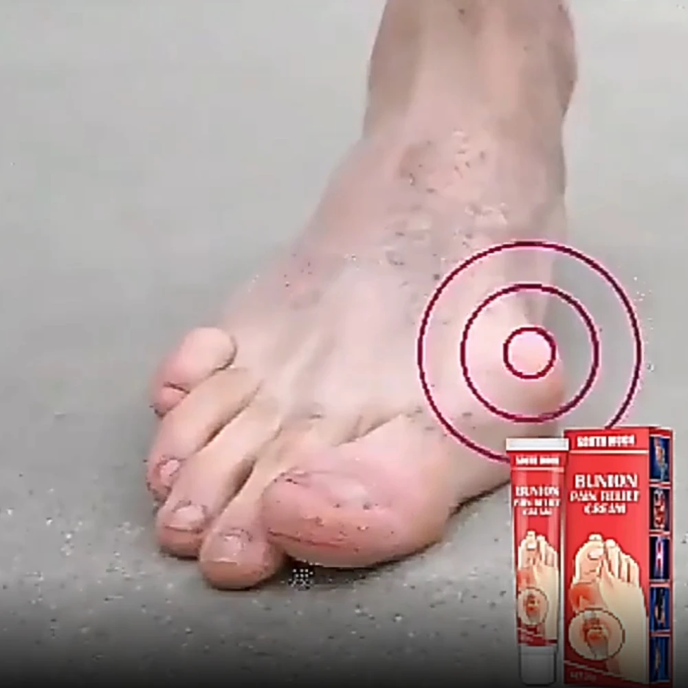 Bunion Pain Relief Ointment Joint Toe Pain Cream Bunion Gout Pain Relief Stiffness Inflammation Treatment Arching Treatment
Bunion Pain Relief Ointment Joint Toe Pain Cream Bunion Gout Pain Relief Stiffness Inflammation Treatment Arching Treatment