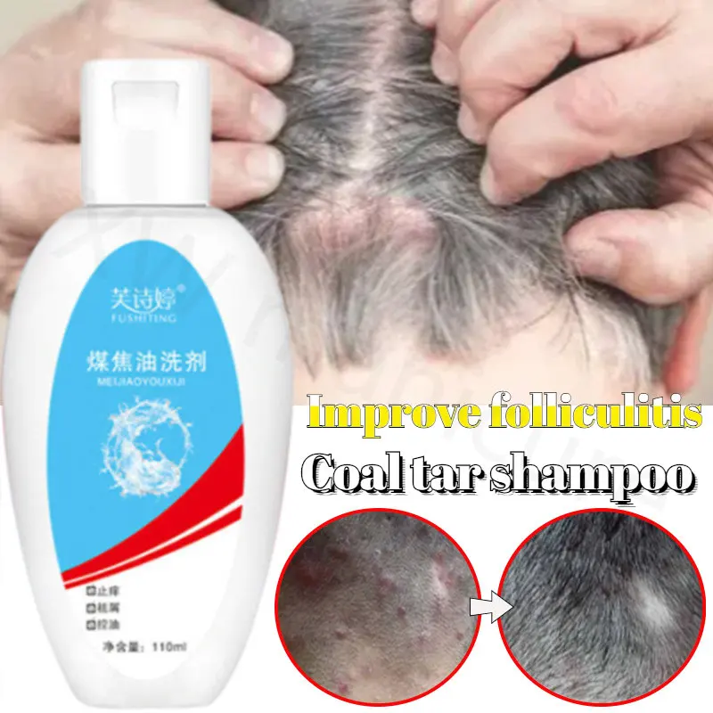 Coal Tar Lotion Shampoo Relieve Scalp Moss Scalp Pimples Improve Dandruff and Greasy Hair Shampoo Antipruritic Control Oil
Coal Tar Lotion Shampoo Relieve Scalp Moss Scalp Pimples Improve Dandruff and Greasy Hair Shampoo Antipruritic Control Oil