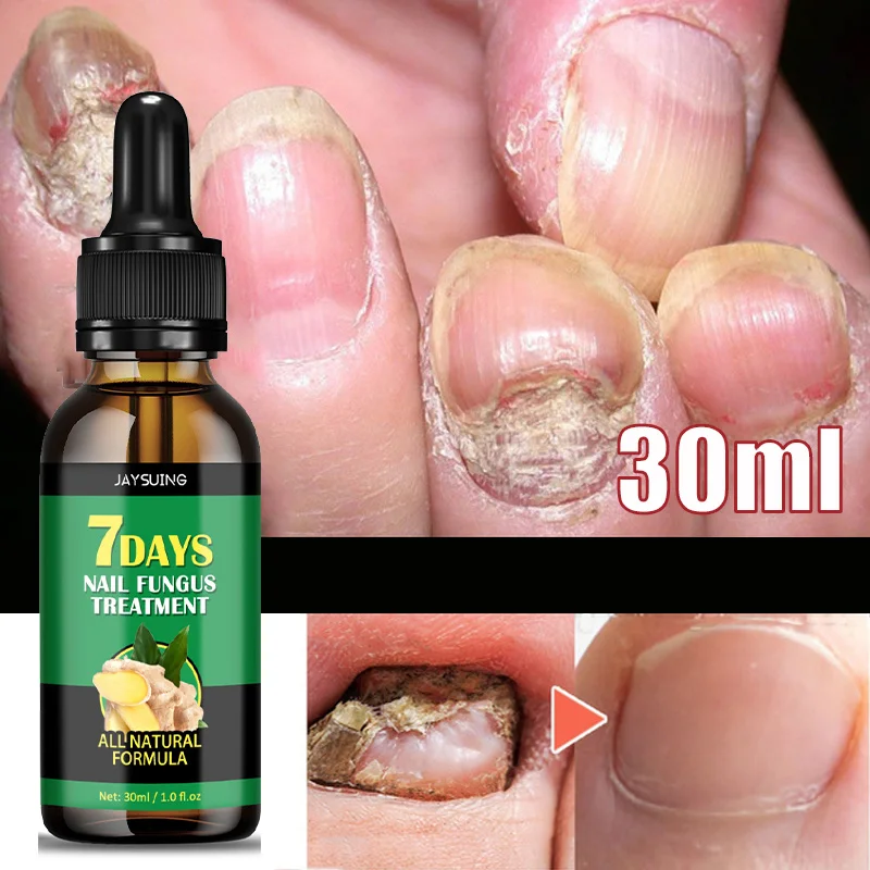 7 Days Ginger Nail Fungal Treatment Essence Anti Infection Foot Care Serum Toe Nails Fungus Onychomycosis Removal Gel Products
7 Days Ginger Nail Fungal Treatment Essence Anti Infection Foot Care Serum Toe Nails Fungus Onychomycosis Removal Gel Products