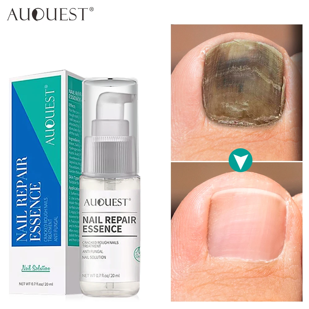 Nail Fungus Treatment Serum Foot Fungal Remove Care Anti Infection Paronychia Onychomycosis Remedy Nail Polish Feet Products
Nail Fungus Treatment Serum Foot Fungal Remove Care Anti Infection Paronychia Onychomycosis Remedy Nail Polish Feet Products