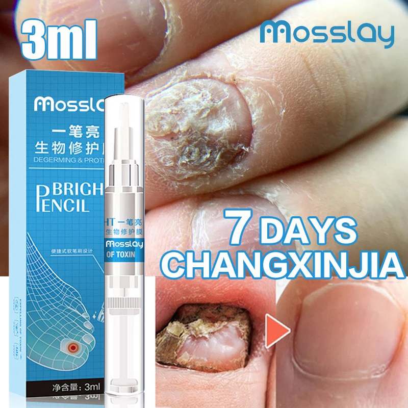 3ml Nail Treatment Pen Nail Care Solution Anti Fungal Nail Infection Repair Liquid Anti Fungus Nail Liquid Nail Care
3ml Nail Treatment Pen Nail Care Solution Anti Fungal Nail Infection Repair Liquid Anti Fungus Nail Liquid Nail Care