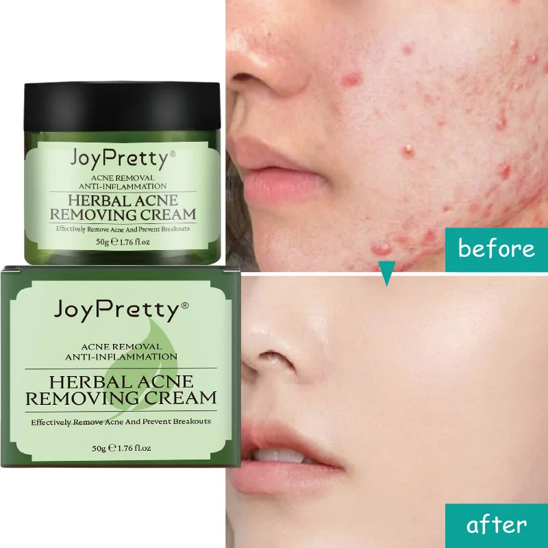 50g Acne Face Cream Plant Essence Pimple Scar Removal Oil Control Shrink Pore Moisturizing Facial Cream Acne Treatment Skin Care
50g Acne Face Cream Plant Essence Pimple Scar Removal Oil Control Shrink Pore Moisturizing Facial Cream Acne Treatment Skin Care