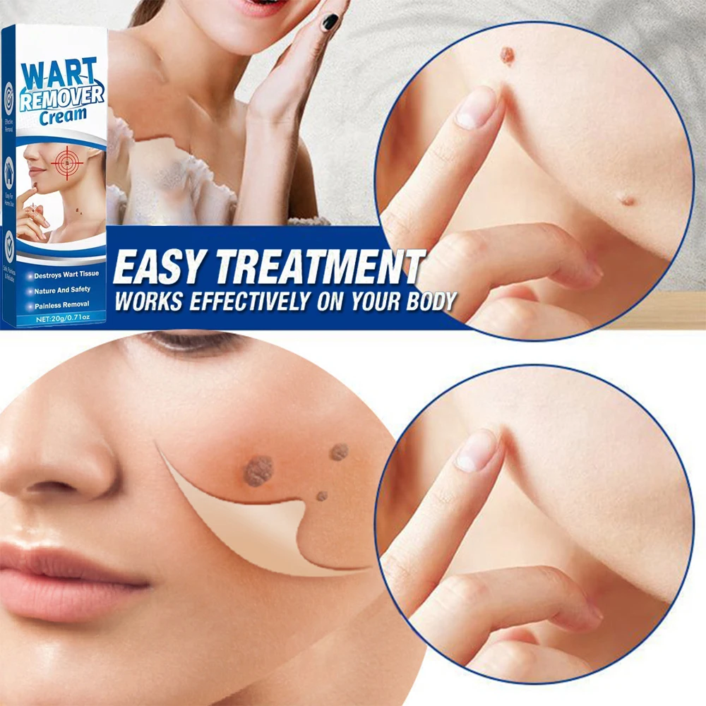 Warts Remover Antibacterial Ointment Skin Tag Remover Genital Herpes Papilloma Ointment Clean Painless Beauty Skin Tag Care Tool
Warts Remover Antibacterial Ointment Skin Tag Remover Genital Herpes Papilloma Ointment Clean Painless Beauty Skin Tag Care Tool