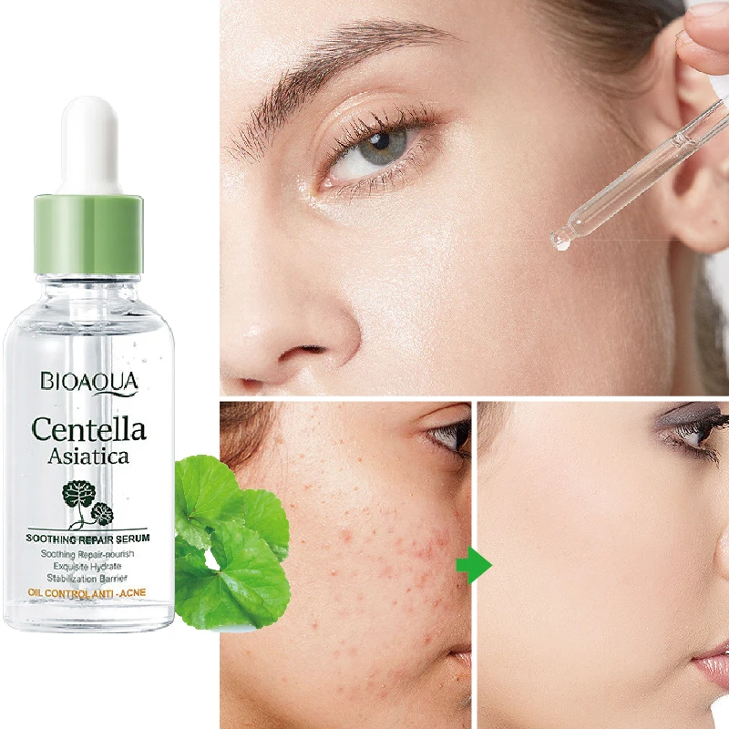 Acne Treatment Face Serum Centella Asiatica Serum Acne Removal Facial Essence Shrink Pores Moisture Nourishing Skin Care Product
Acne Treatment Face Serum Centella Asiatica Serum Acne Removal Facial Essence Shrink Pores Moisture Nourishing Skin Care Product