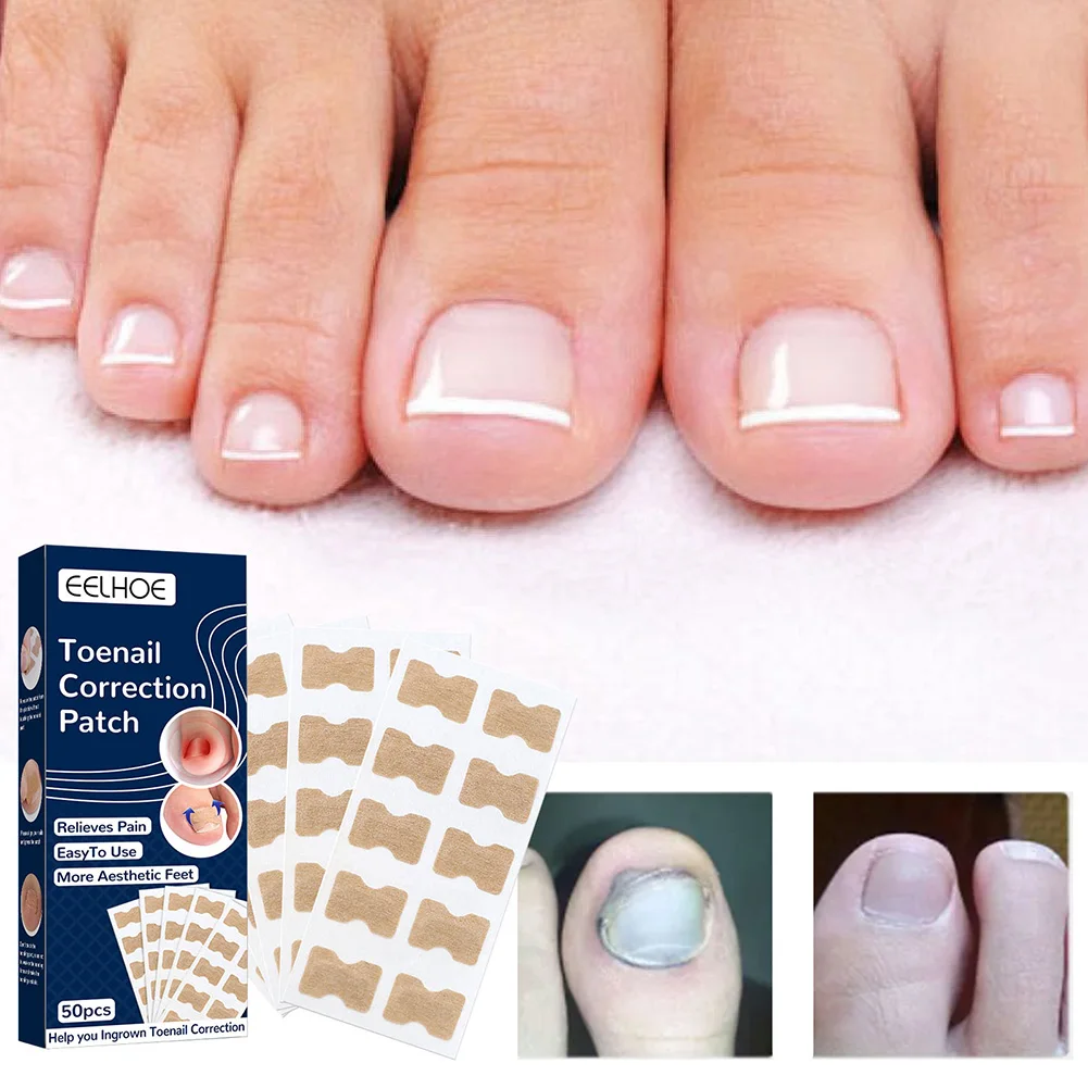 50Pcs Ingrown Toenail Nail Correction Sticker Self Adhesive Toenail Patches Paronychia Treatment Recover Sticker Foot Care Tool
50Pcs Ingrown Toenail Nail Correction Sticker Self Adhesive Toenail Patches Paronychia Treatment Recover Sticker Foot Care Tool