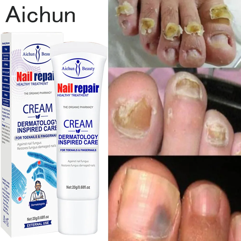 20g Nail Fungal Treatment Feet Care Cream Anti-fungal Infection Paronychia Onychomycosis Removal Toe Fungus Ointment Products
20g Nail Fungal Treatment Feet Care Cream Anti-fungal Infection Paronychia Onychomycosis Removal Toe Fungus Ointment Products