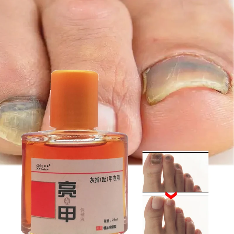 

3/5pcs 25ml Natural Nail Fungus Treat Serum Anti-Infection Onychomycosis Antibacterial Solution Toe Nails Fungal Removal Liquid