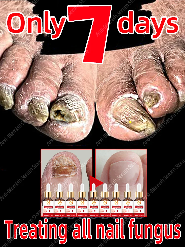 Nail Fungal Treatment Serum Onychomycosis Paronychia Anti Infection Toe Fungus Hand
Nail Fungal Treatment Serum Onychomycosis Paronychia Anti Infection Toe Fungus Hand