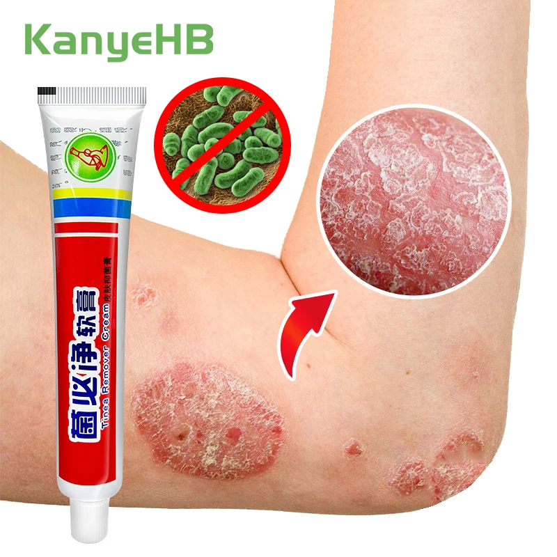 1pcs Anti-fungal Anti-itch Psoriasis Cream Anti-inflammatory Treat Rash Eczema Dermatitis Tinea Pedis Cream Eczema Ointment S081
1pcs Anti-fungal Anti-itch Psoriasis Cream Anti-inflammatory Treat Rash Eczema Dermatitis Tinea Pedis Cream Eczema Ointment S081