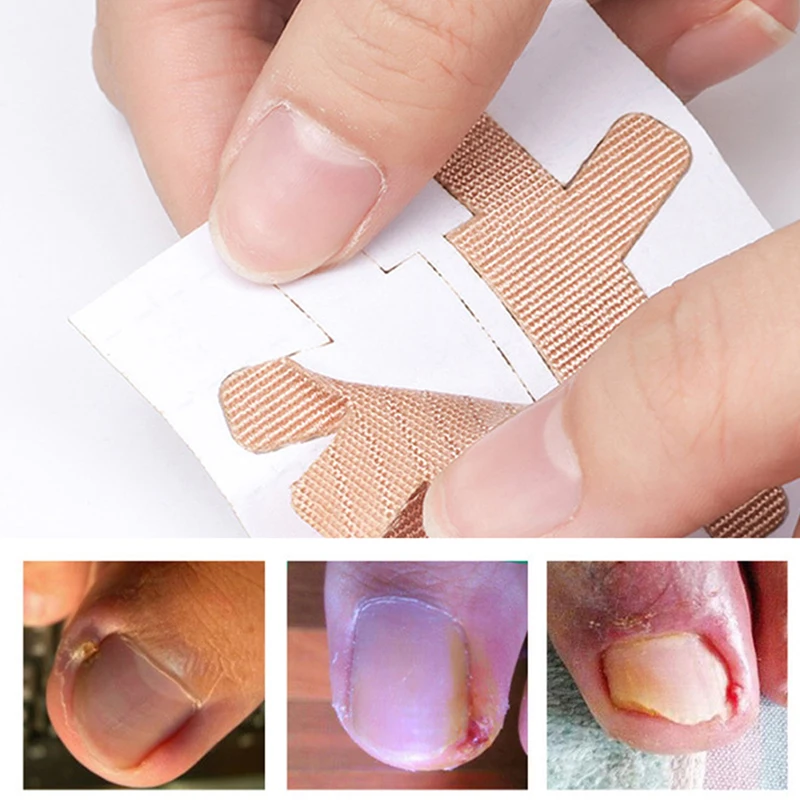 4Pcs Pedicure Ingrown Nail Tool Toenail Stickers For Nail Corrector Paronychia Treatment Fixer Recover Bunion Feet Care Tool
4Pcs Pedicure Ingrown Nail Tool Toenail Stickers For Nail Corrector Paronychia Treatment Fixer Recover Bunion Feet Care Tool