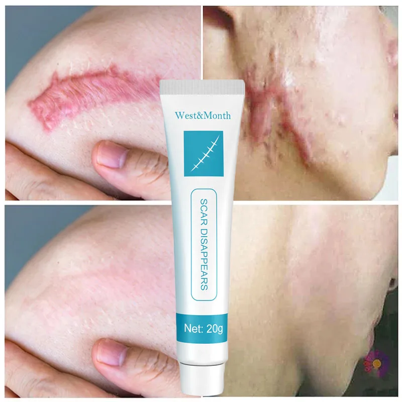 Acne Scar Removal Cream Pimples Surgical Scar Stretch Marks Face Gel Remove Smoothening Whitening Body Skin Care Pigmentation
Acne Scar Removal Cream Pimples Surgical Scar Stretch Marks Face Gel Remove Smoothening Whitening Body Skin Care Pigmentation