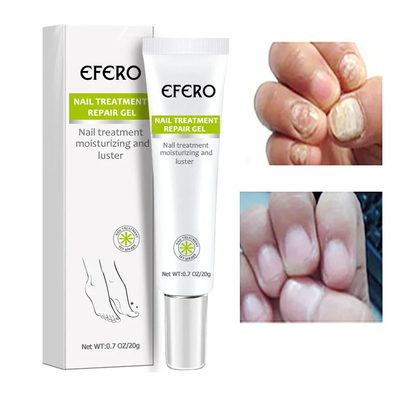 Сыворотка для лечения Ногтей от грибков, гель для удаления грибка ногтей, антиинфекционный онихомикоз, восстанавливающий экстракт для ногт...
Сыворотка для лечения Ногтей от грибков, гель для удаления грибка ногтей, антиинфекционный онихомикоз, восстанавливающий экстракт для ногт...