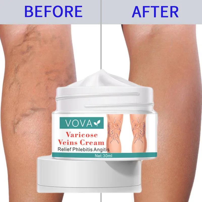Herbal Varicose Veins Treatment Cream Tired Legs Dilated Vasculitis Phlebitis Spider Pain Angiitis Ointment Body Health Care
Herbal Varicose Veins Treatment Cream Tired Legs Dilated Vasculitis Phlebitis Spider Pain Angiitis Ointment Body Health Care