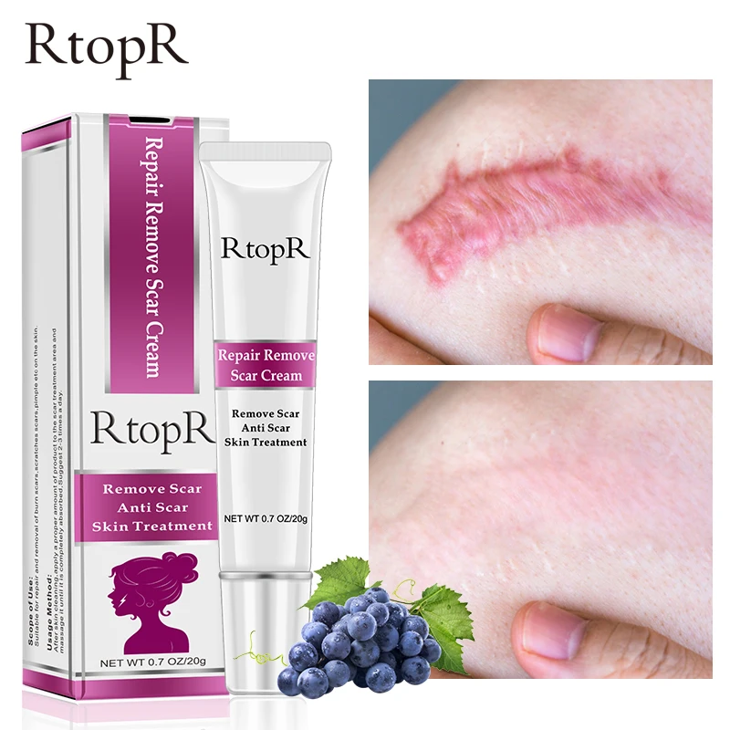 Крем для шрамов от акне RtopR, отбеливающий крем для лица, прыщей, темных пятен, растяжек, удаление черных точек, Восстанавливающий уход за коже... 
Крем для шрамов от акне RtopR, отбеливающий крем для лица, прыщей, темных пятен, растяжек, удаление черных точек, Восстанавливающий уход за коже...