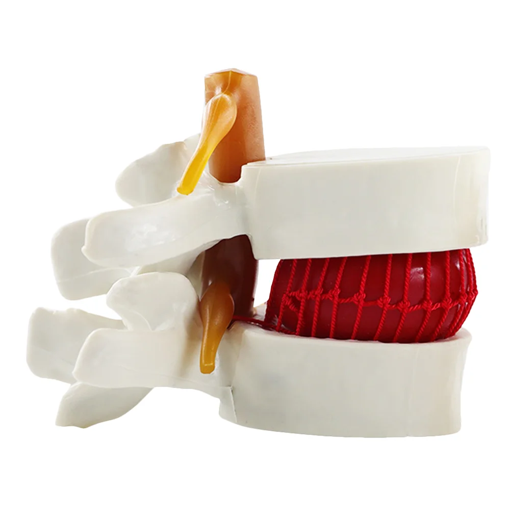 Model Lumbar Spine Herniation Disc Human Anatomical Vertebral Teaching Tool School Supplies 1.5X Magnification Intervertebral
Model Lumbar Spine Herniation Disc Human Anatomical Vertebral Teaching Tool School Supplies 1.5X Magnification Intervertebral