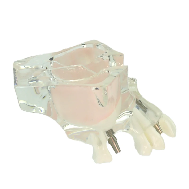 Стоматологическая имплантация, модель зубов, стоматологические материалы, стоматологический инструмент, обучение стоматологии, модель зубов
Стоматологическая имплантация, модель зубов, стоматологические материалы, стоматологический инструмент, обучение стоматологии, модель зубов