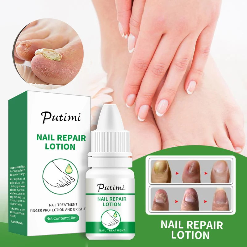 PUTIMI Nail Treatments Essence Feet Care Nails Fungus Foot Toe Fungal Removal Gel Anti Infection Paronychia Onychomycosis Repair
PUTIMI Nail Treatments Essence Feet Care Nails Fungus Foot Toe Fungal Removal Gel Anti Infection Paronychia Onychomycosis Repair