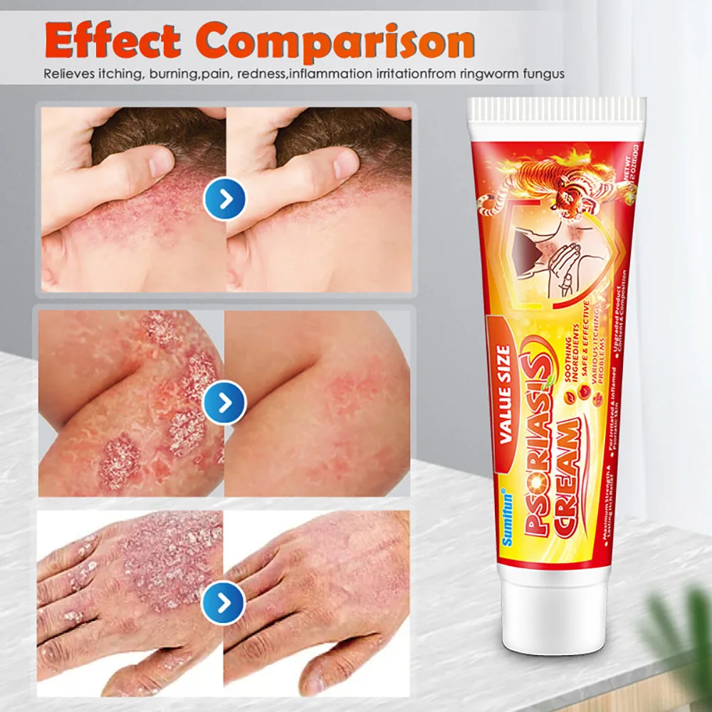 Herbal Topical Psoriasis Ointment Skin Rash Desquamation Antipruritic Antibacterial Herbals Psoriasis Treatment Ointment Cream
Herbal Topical Psoriasis Ointment Skin Rash Desquamation Antipruritic Antibacterial Herbals Psoriasis Treatment Ointment Cream