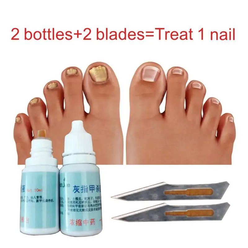 nail podiatry ingrown toenail onychomycosis antifungal for nail fungus ointment cream fungal foot care removal treatment remedy
nail podiatry ingrown toenail onychomycosis antifungal for nail fungus ointment cream fungal foot care removal treatment remedy