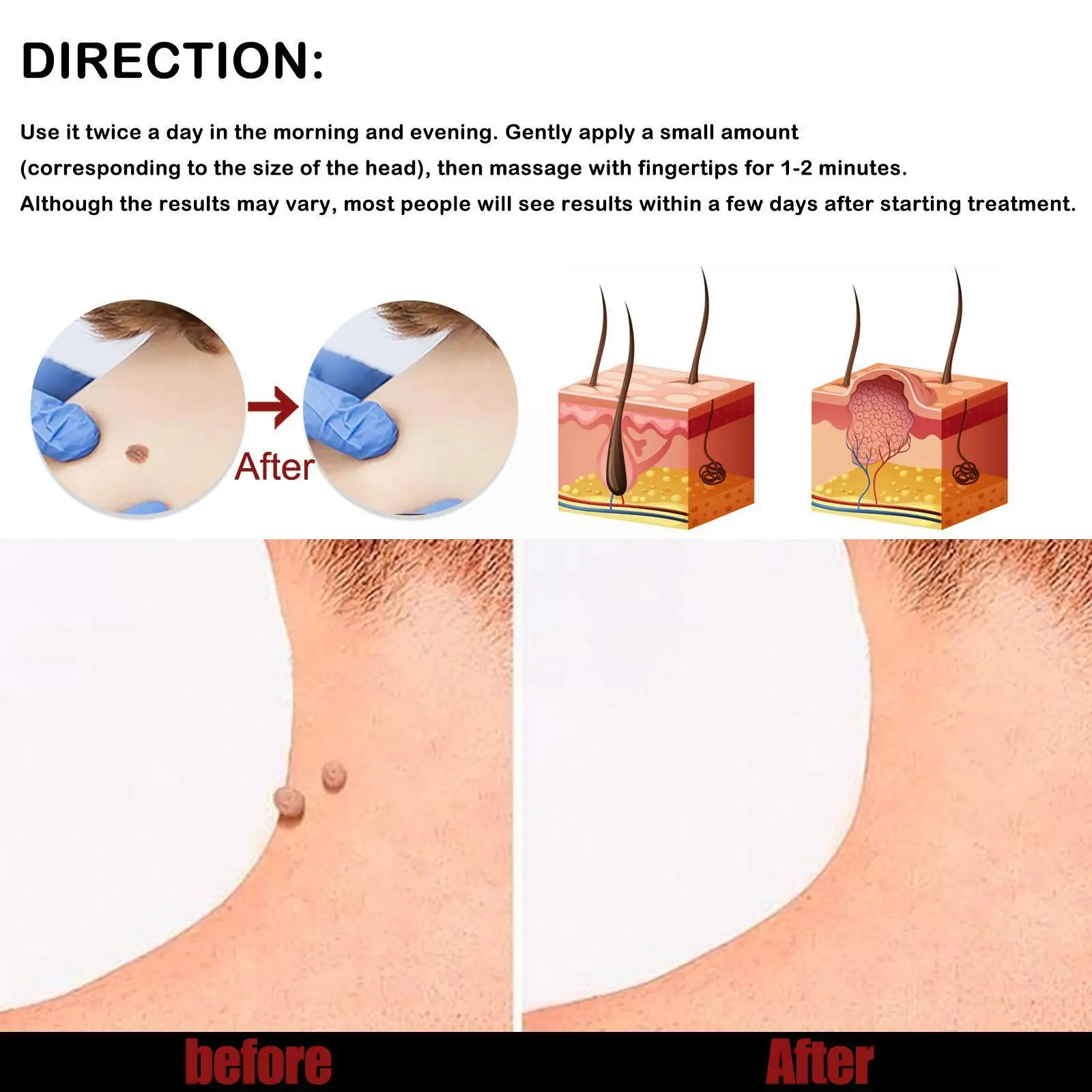 Skin Tag Remover Cream Painless Mole Skin Dark Spot Wart Freckle Essential Warts Oil Treatment Serum Tag Remover Face Remov E9X1
Skin Tag Remover Cream Painless Mole Skin Dark Spot Wart Freckle Essential Warts Oil Treatment Serum Tag Remover Face Remov E9X1