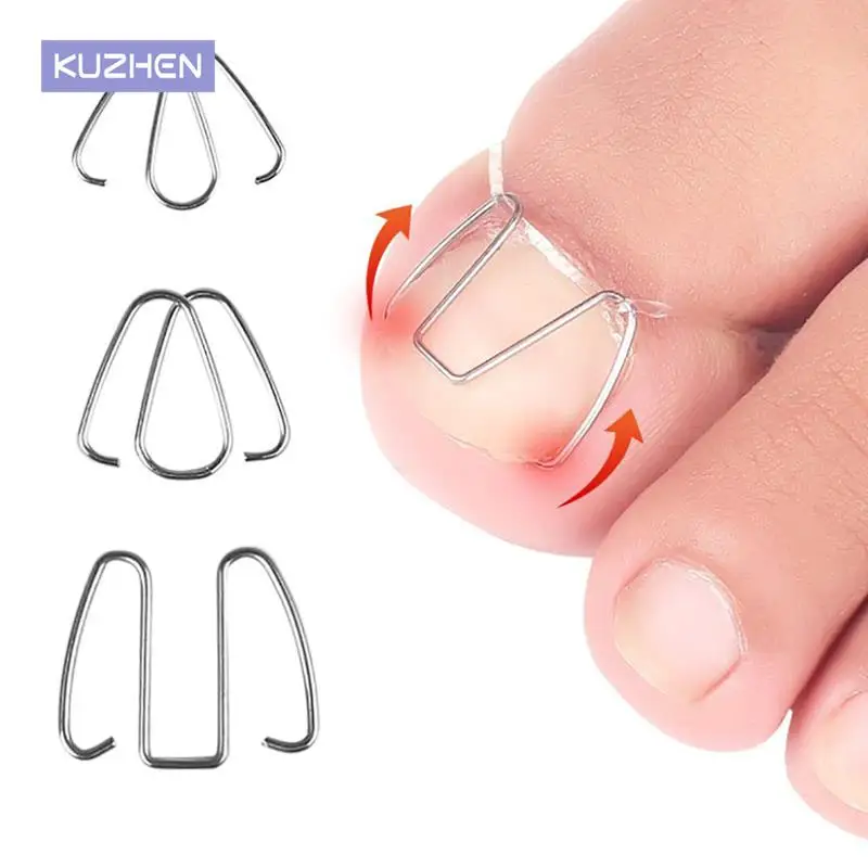 Front Nail Hook/Rubber Band Nail Art Ingrown Toe Nail Correction Toenail Nail Ingrown Clip Orthosis Paronychia Pedicure Care
Front Nail Hook/Rubber Band Nail Art Ingrown Toe Nail Correction Toenail Nail Ingrown Clip Orthosis Paronychia Pedicure Care