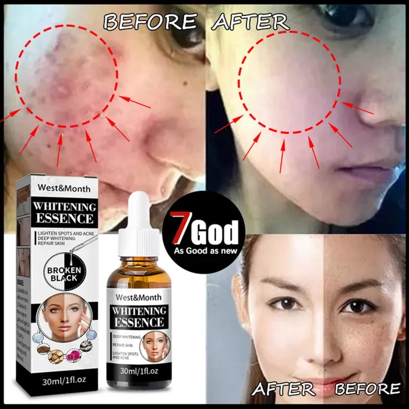 Freckle Whitening Serum Corrector Skin Lightening Blemish Removal Serum Fade Cream Reduces Age Spots Brighten Nourish Skin Care
Freckle Whitening Serum Corrector Skin Lightening Blemish Removal Serum Fade Cream Reduces Age Spots Brighten Nourish Skin Care