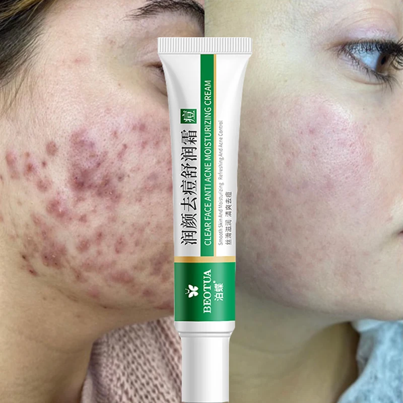 20g Effective Acne Removal Cream Facial Acne Spots Anti-aging Oil Control Acne Cream Whitening Moisturizing Face Gel Skin Care
20g Effective Acne Removal Cream Facial Acne Spots Anti-aging Oil Control Acne Cream Whitening Moisturizing Face Gel Skin Care