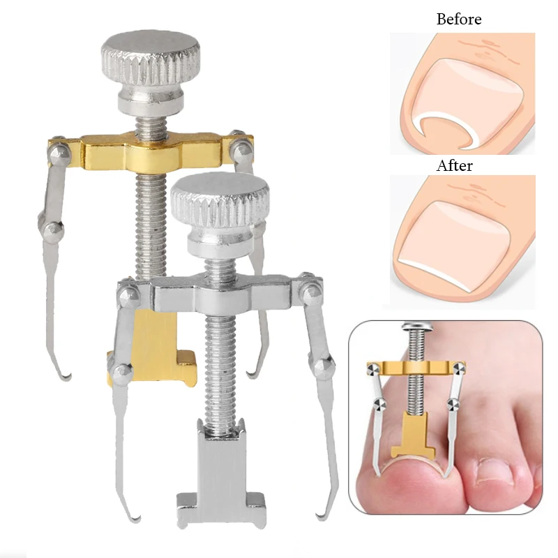 Straightening Clip Ingrown Toenail Corrector Pedicure Foot Nail Care Tools Stainless Steel Pedicure Treatment Onyxis Correction
Straightening Clip Ingrown Toenail Corrector Pedicure Foot Nail Care Tools Stainless Steel Pedicure Treatment Onyxis Correction