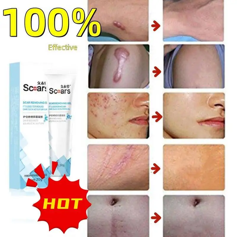 Fast Scar Removal Cream For Old Scars Cream And Deep Permanently Mark Gel Scar Repair Treatment Repair Scar Removal Cream Gel
Fast Scar Removal Cream For Old Scars Cream And Deep Permanently Mark Gel Scar Repair Treatment Repair Scar Removal Cream Gel