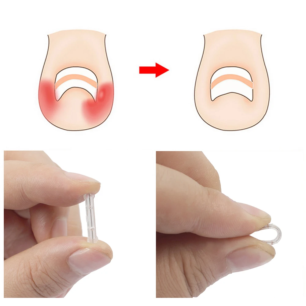 50pcs Nail Correction Stickers Durable Silicone Ingrown Toe Nail Straightening Sticker 7 Sizes Unisex Nails Health Care Supplies
50pcs Nail Correction Stickers Durable Silicone Ingrown Toe Nail Straightening Sticker 7 Sizes Unisex Nails Health Care Supplies