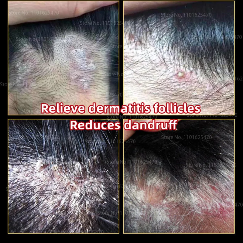 Scalp Hair Follicle Cleansing Shampoo Antibacterial Anti-itching Mites Oil Control Psoriasis, Keratin Hair Treatment Skin Care
Scalp Hair Follicle Cleansing Shampoo Antibacterial Anti-itching Mites Oil Control Psoriasis, Keratin Hair Treatment Skin Care