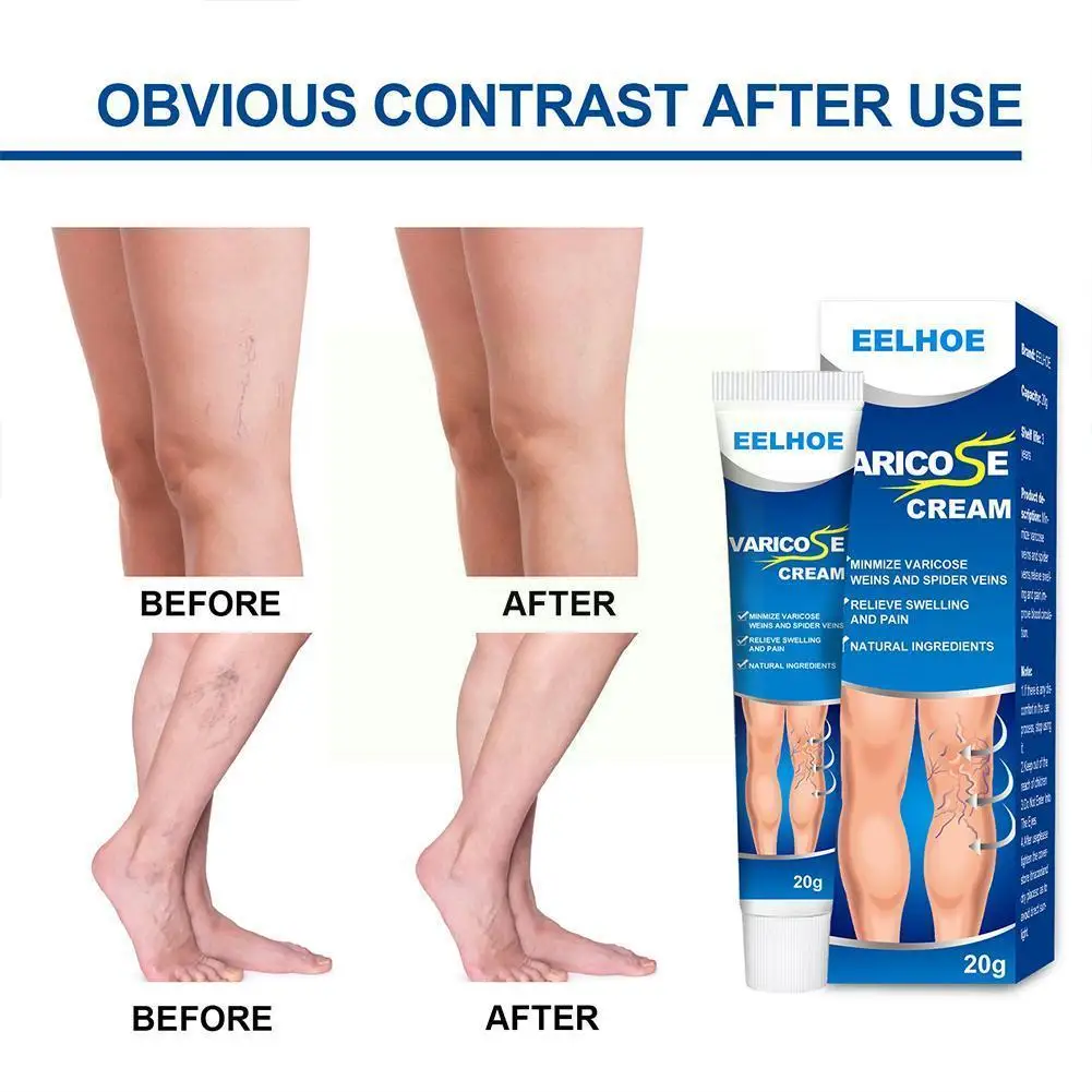 1pcs Varicose Vein Treatment Cream Spider Ointment Herbal Varicose Plaster Angiitis Medical 20g Removal E9J1
1pcs Varicose Vein Treatment Cream Spider Ointment Herbal Varicose Plaster Angiitis Medical 20g Removal E9J1