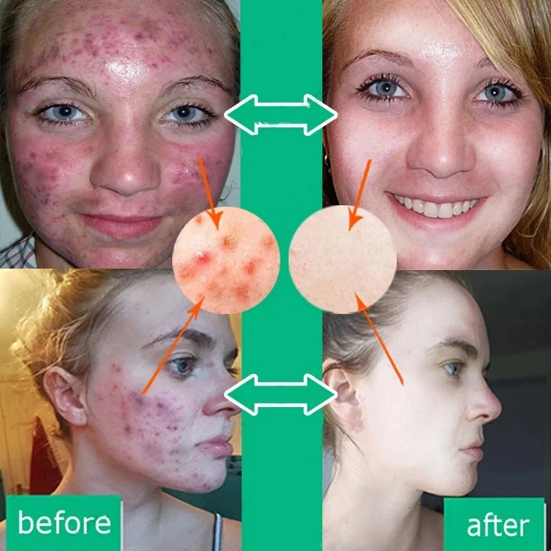 Acne Remove Cream Salicylic Acid Face Oil Control Pore Contraction Acne Spot Marks Treatment Tea Tree Herbal Skin Care Ointment
Acne Remove Cream Salicylic Acid Face Oil Control Pore Contraction Acne Spot Marks Treatment Tea Tree Herbal Skin Care Ointment
