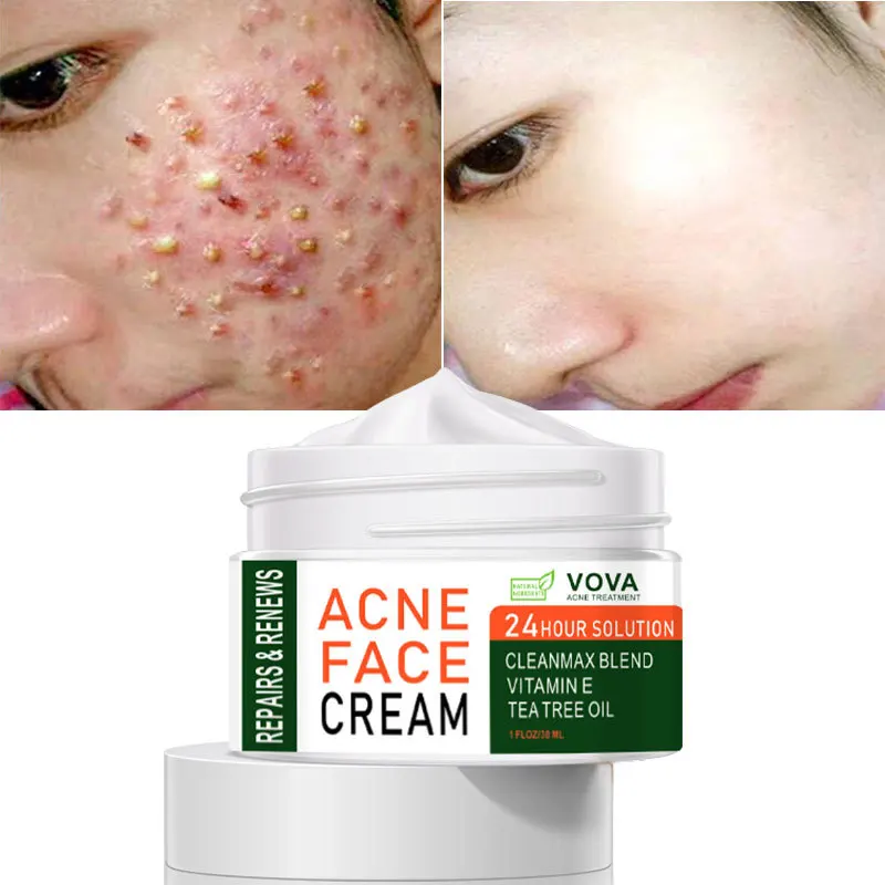 Acne Face Creams Herbal Pimple Scar Removal Shrink Pore Oil Control Moisturizing Facial Cream Acne Treatment Skin Care
Acne Face Creams Herbal Pimple Scar Removal Shrink Pore Oil Control Moisturizing Facial Cream Acne Treatment Skin Care