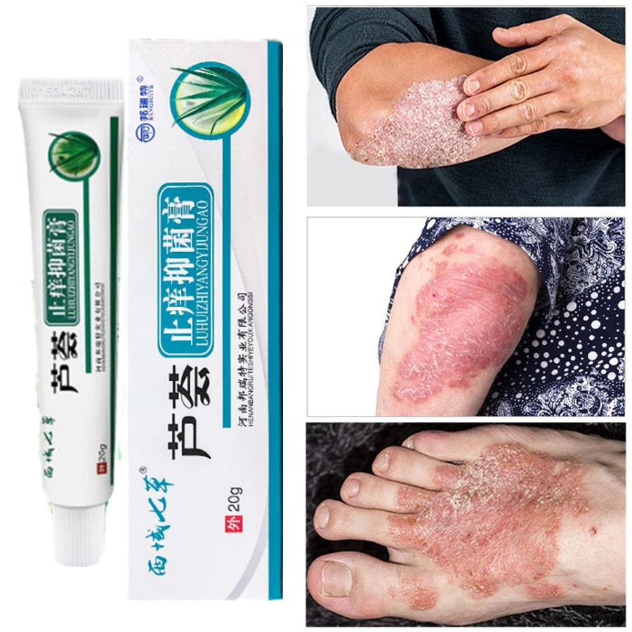20G Antibacterial Psoriasis Cream Herbal Relief Dermatitis Eczema Treatment Urticaria Effective Anti-Itch Desquamation Skin Care
20G Antibacterial Psoriasis Cream Herbal Relief Dermatitis Eczema Treatment Urticaria Effective Anti-Itch Desquamation Skin Care