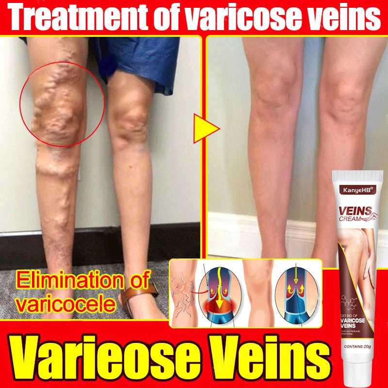 Effective Varicose Vein Relief Cream Ointment For Varicose Veins To Relieve Vasculitis Phlebitis Spider Pain Treatment
Effective Varicose Vein Relief Cream Ointment For Varicose Veins To Relieve Vasculitis Phlebitis Spider Pain Treatment